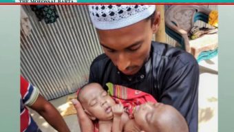 চিকিৎসাধীন জোড়া লাগা জমজ দুই বোনের মৃত্যু